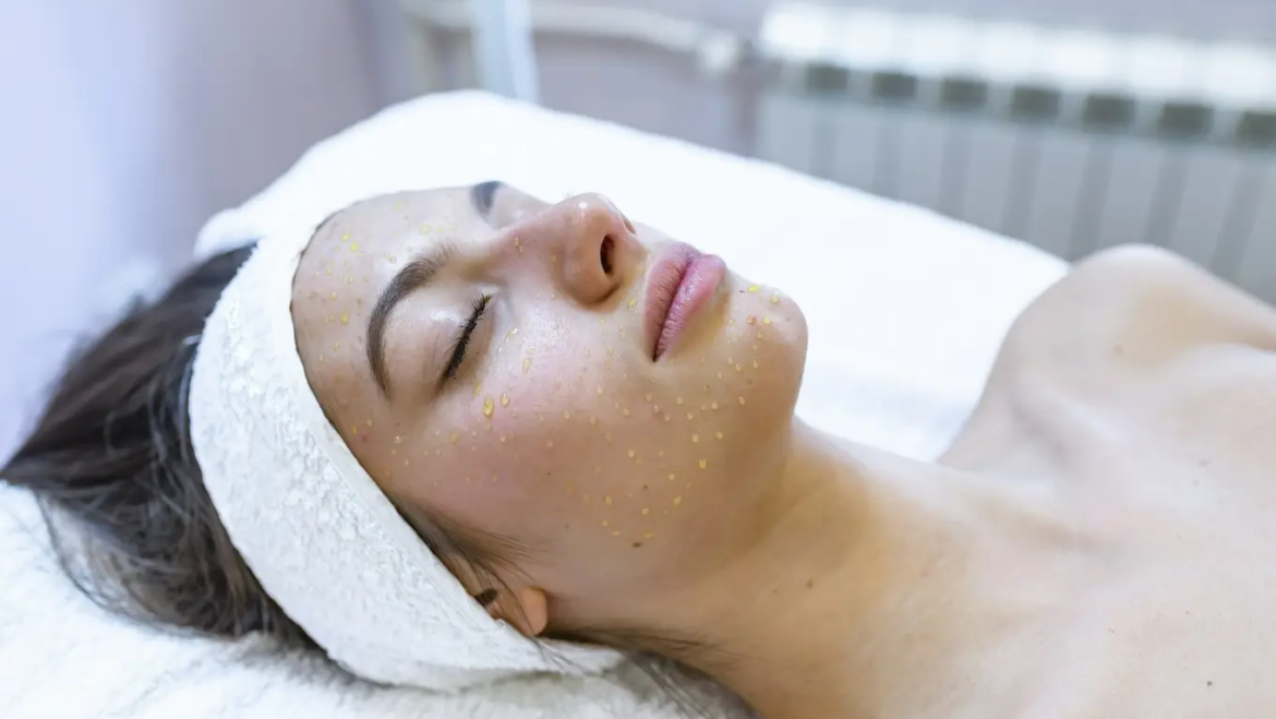 kobieta po zabiegu mezoterapii igłowej