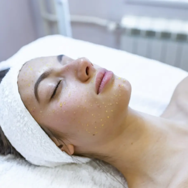 kobieta po zabiegu mezoterapii igłowej