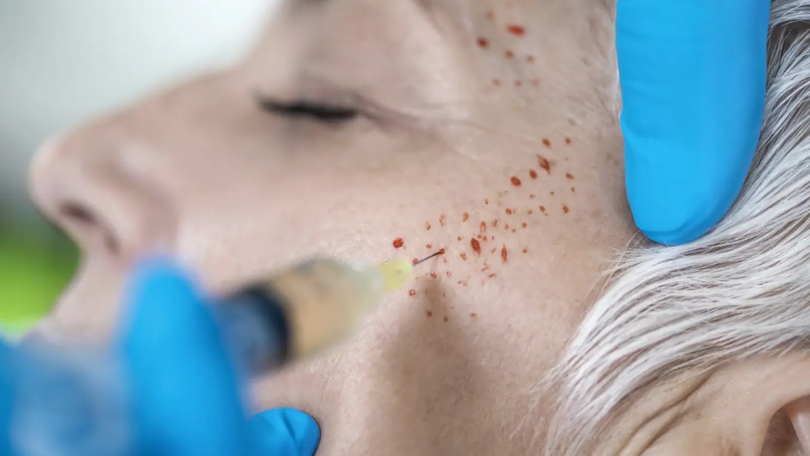 mikronakłuwanie twarzy