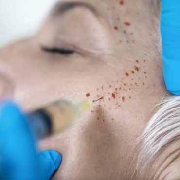 Home mikronakluwanie twarzy 370x370 - Home